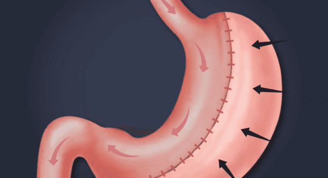 Transform Your Life: Why Gastric Sleeve Surgery in Gold Coast Is Worth Considering